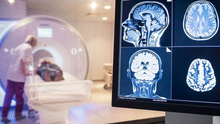 Un estudio no encuentra signos de lesión cerebral permanentes a largo plazo tras la COVID-19
