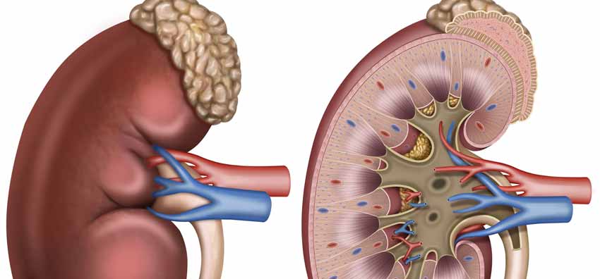 ¿En qué afecta tener los niveles de ácido úrico anormales?