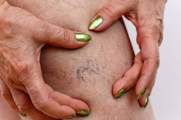 Los mejores consejos para que nunca te salgan varices 4 ¿Cómo evitar las varices?