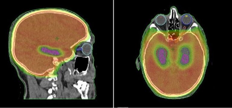 Estudio cambia el abordaje del tratamiento de la metástasis cerebral en cáncer de pulmón