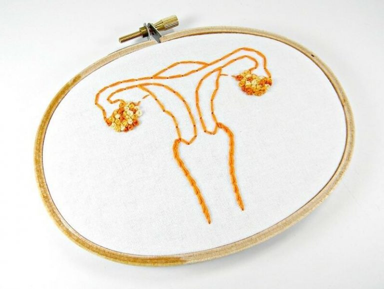 La mayoría de pacientes con cáncer de ovario debuta con enfermedad extendida