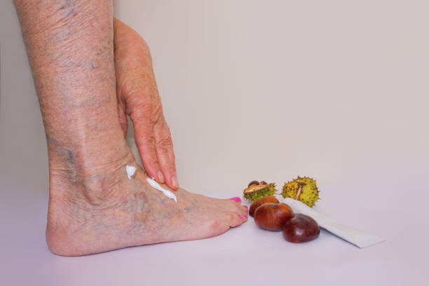 Los mejores consejos para que nunca te salgan varices 6 Elimina las varices con artillería pesada