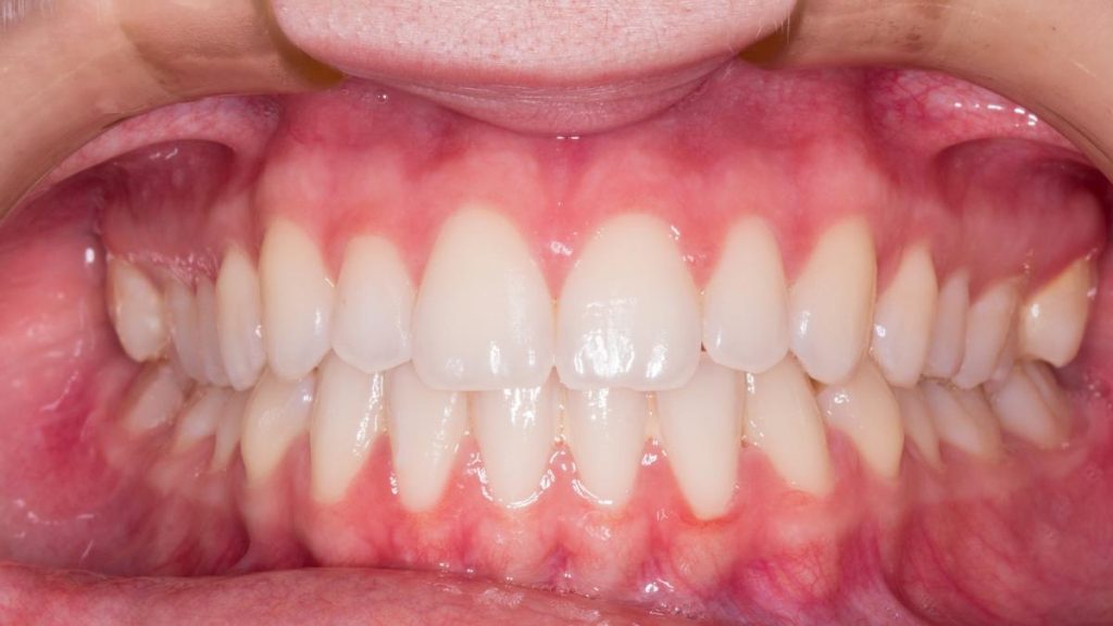 Agua oxigenada: otros usos además de desinfectar 324 Cuida tus encías con agua oxigenada