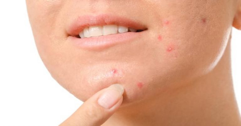 Tratar el acné desde varias esferas: dermatología, dieta y sueño