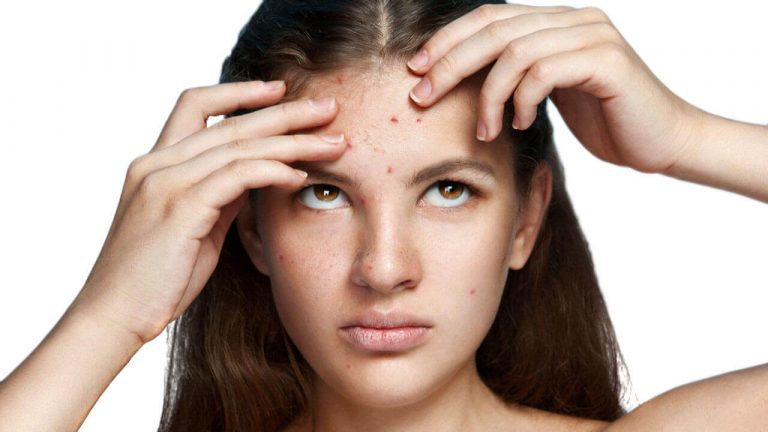 Este es el motivo por el que tienes acné antes de la regla