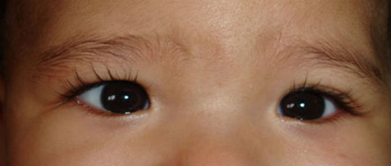 ¿Qué caracteriza al falso estrabismo?