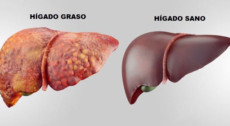 Qué es el hígado graso 43 ¿Qué es el hígado graso?