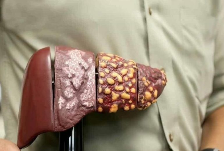 Qué es el hígado graso 45 ¿Qué causas el hígado graso?