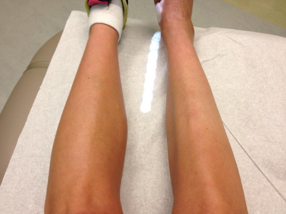 Qué es la atrofia muscular 2 ¿Cuáles son los síntomas de la atrofia muscular?