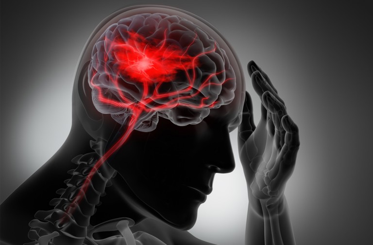 Qué es un ictus 14 ¿Qué es el ictus?