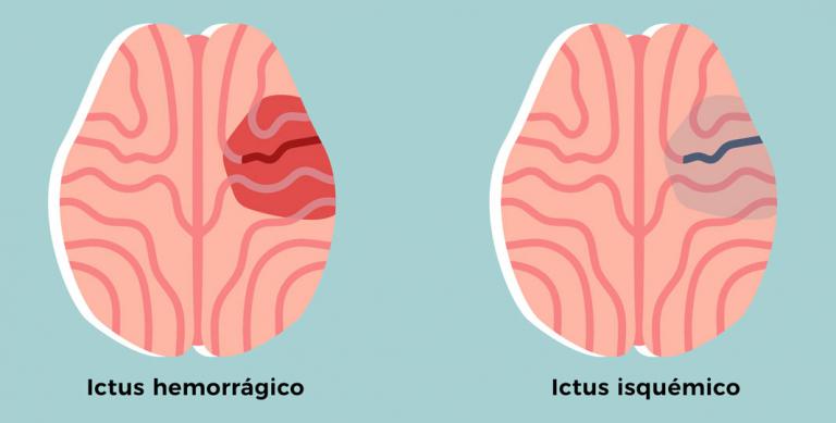 Qué es un ictus 17 ¿Se puede detectar un ictus?