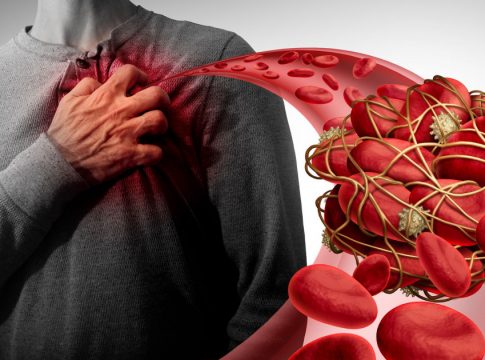 Qué es una embolia 1 Qué es una embolia