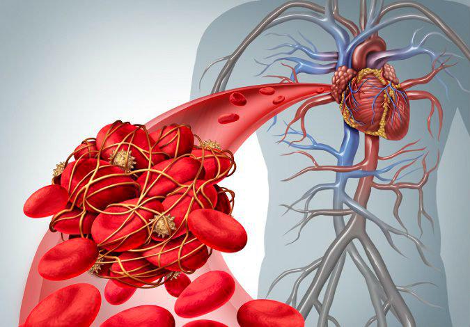 Qué es una embolia 3 ¿Cuáles son las 5 causas más comunes de originarse una embolia?