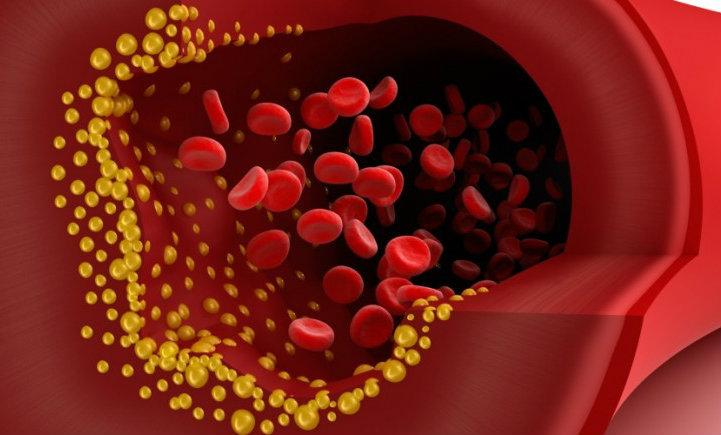 Qué es una embolia 4 ¿Cuáles son los factores de riesgo para que se produzca una embolia?