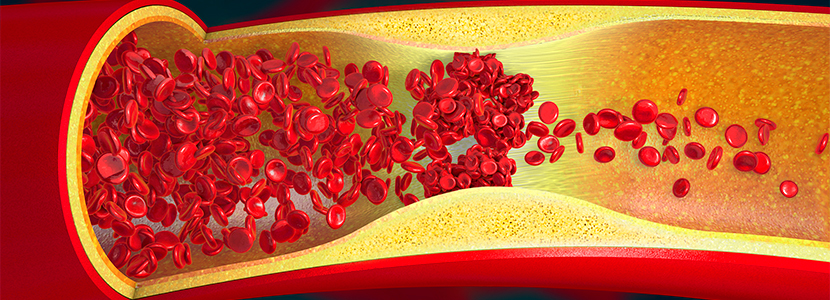 Qué es una embolia 5 ¿Después de una embolia hay tratamiento?