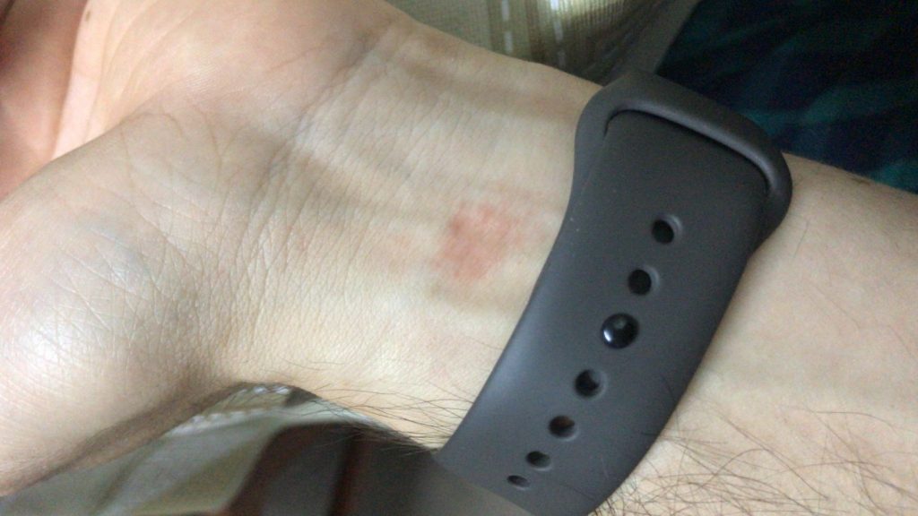 Qué hacer si Apple Watch te ha quemado o provocado reacciones en tu piel 71 erupciones en la piel