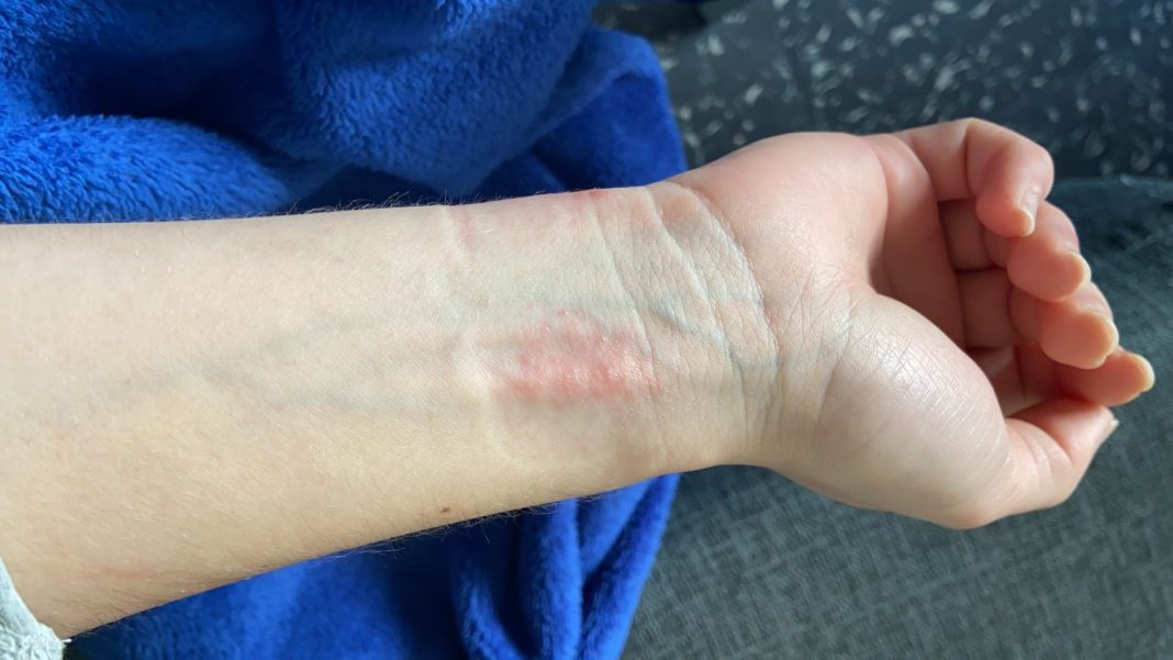 Qué hacer si Apple Watch te ha quemado o provocado reacciones en tu piel