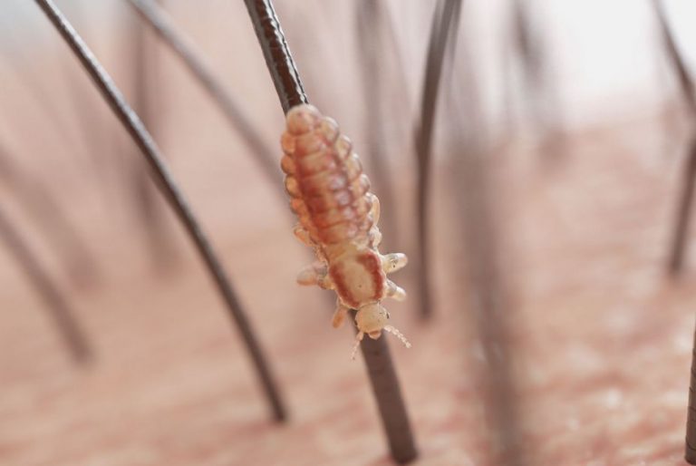 Remedios infalibles contra los piojos y liendres