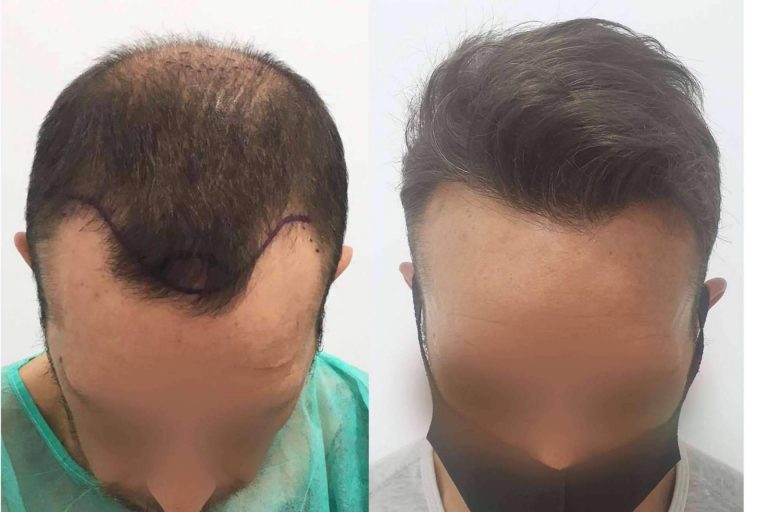 Los famosos también apuestan por el injerto capilar, por Injermur