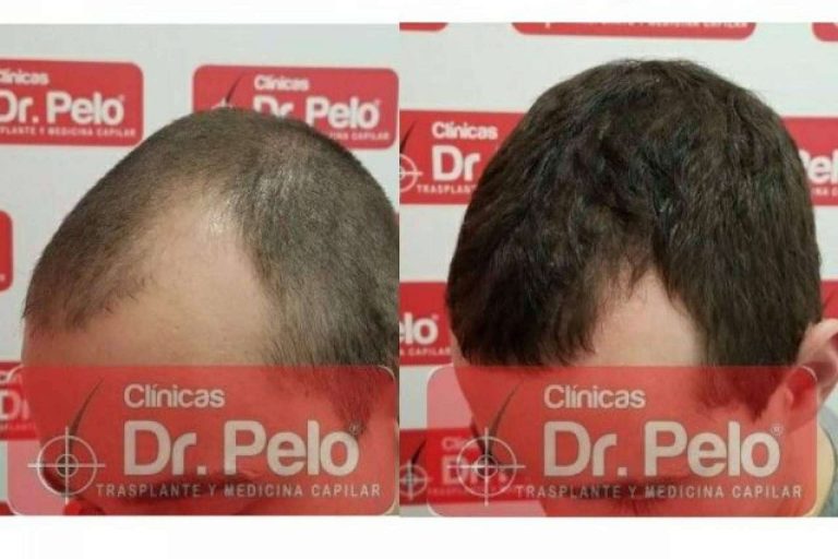 Resultados visibles con el láser capilar LedHair de Dr. Pelo