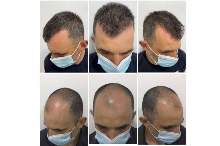 ¿En qué consiste el tratamiento de mesoterapia capilar?