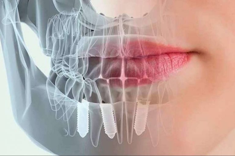 Las ventajas del servicio de implantología inmediata de la Clínica Blay Monzó