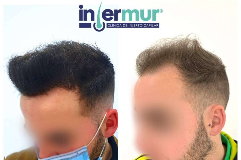 Técnica de injerto capilar sin cicatriz en Injermur
