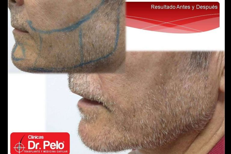 el trasplante de barba, uno de los tratamientos con mejores resultados