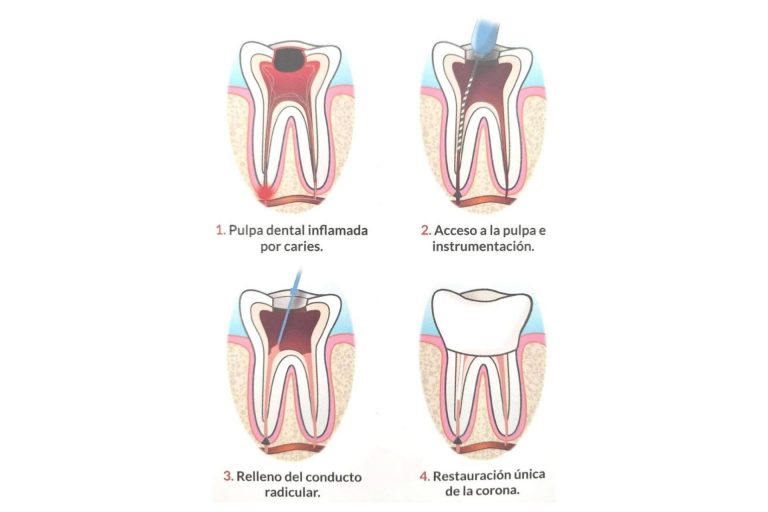 Implant Clinics garantiza resultados satisfactorios en el procedimiento de endodoncia