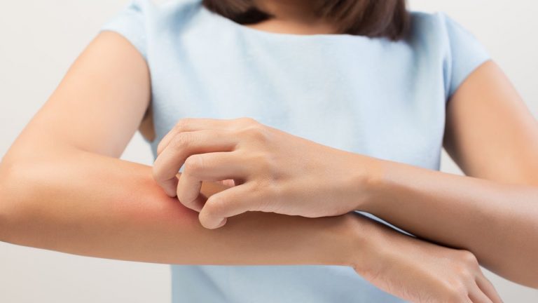 La razón por la que siempre te pican a ti los mosquitos