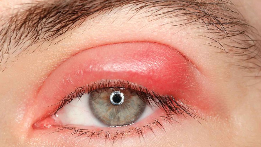 Así puedes curar un orzuelo en 24 horas