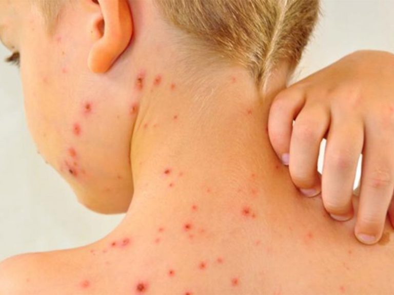 Qué es el sarampión