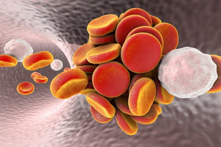 Qué es el tromboembolismo