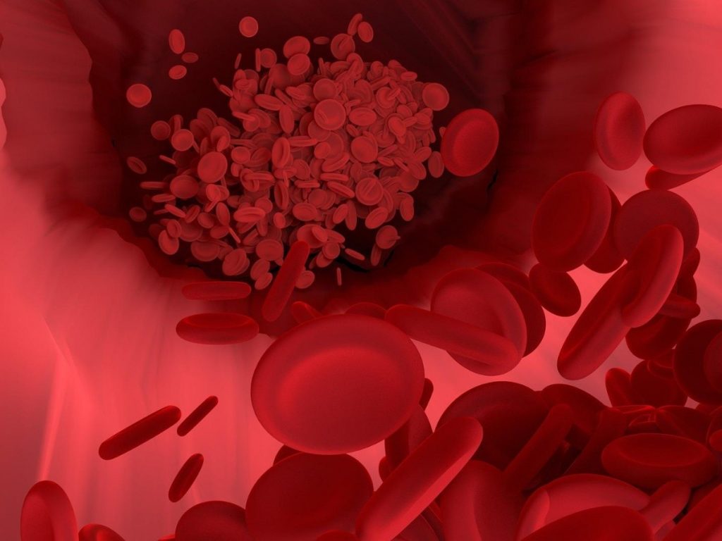 ¿Cuáles son los síntomas de un tromboembolismo?