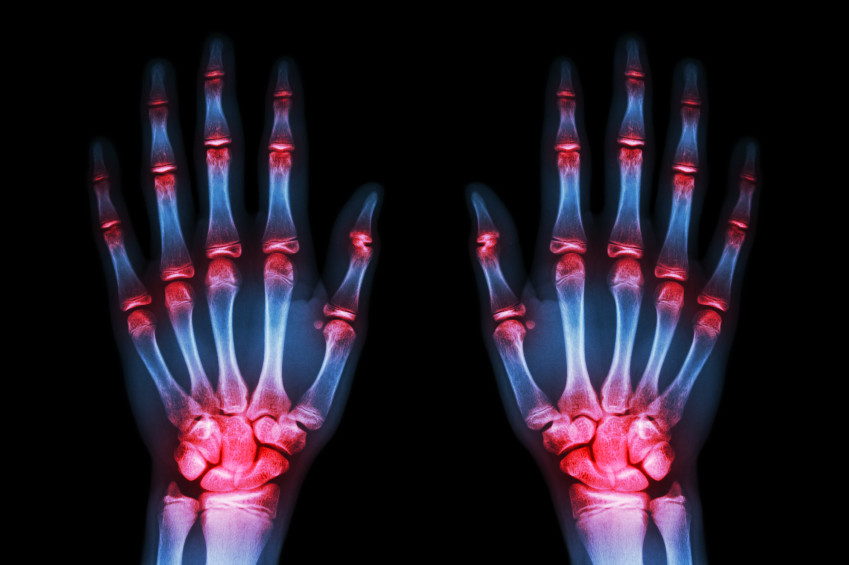 ¿Qué es la artritis y en qué se diferencia de la artrosis? 1 ¿Cómo surgen estas dolencias?