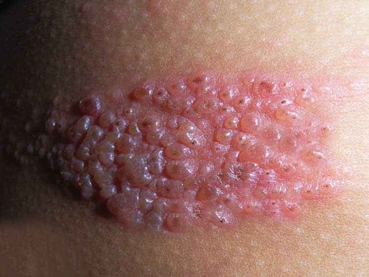 ¿Cómo se diagnostica y cuál es el tratamiento de la culebrilla?