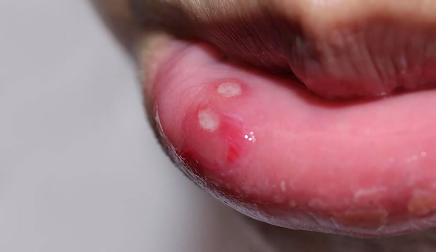 ¿Qué es la enfermedad del beso?