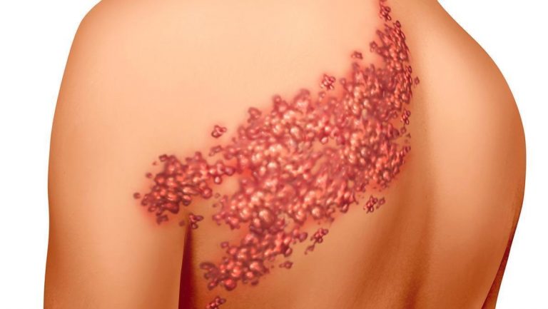 Qué es una culebrilla en el cuerpo