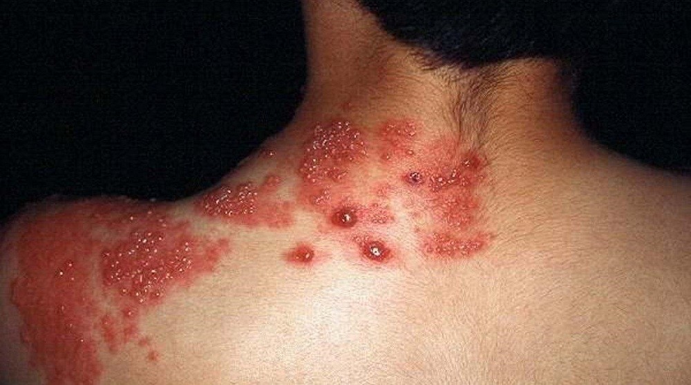 ¿Qué es la culebrilla en el cuerpo?