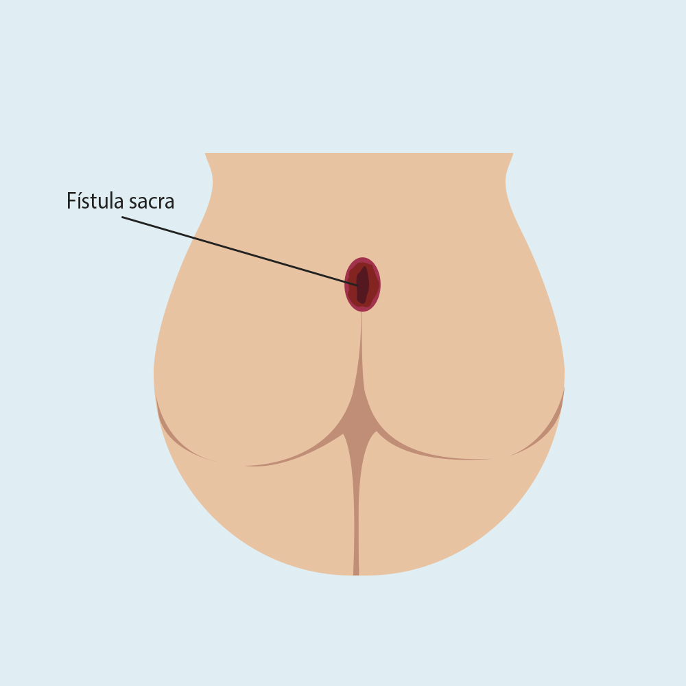 ¿Qué es una fístula?