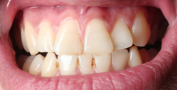 Cómo eliminar el sarro de los dientes de forma natural