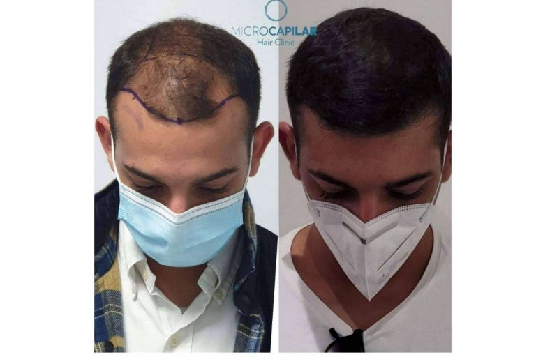 ¿Cuáles son las ventajas de realizar un injerto capilar en España con el servicio de Microcapilar Hair Clinic?