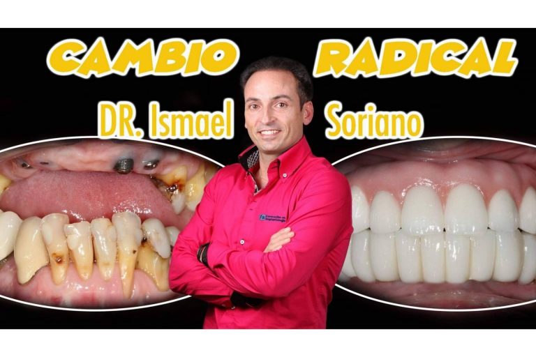 El Dr. Ismael Soriano realiza una técnica de implantes con dientes inmediatos que brinda múltiples beneficios a los pacientes