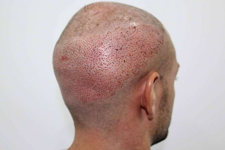 ¿Qué técnicas emplea Clínicas Be al realizar un injerto capilar?