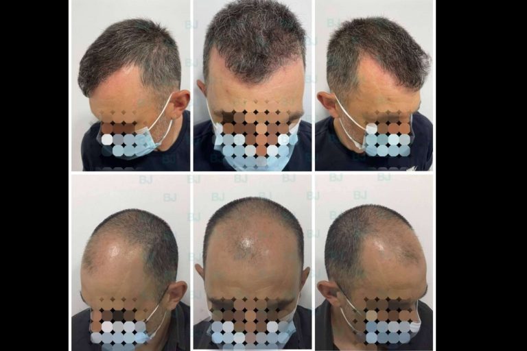 Dr. Bruno Jacobovski, el especialista en injerto capilar en Barcelona que ha logrado más de 500 intervenciones exitosas