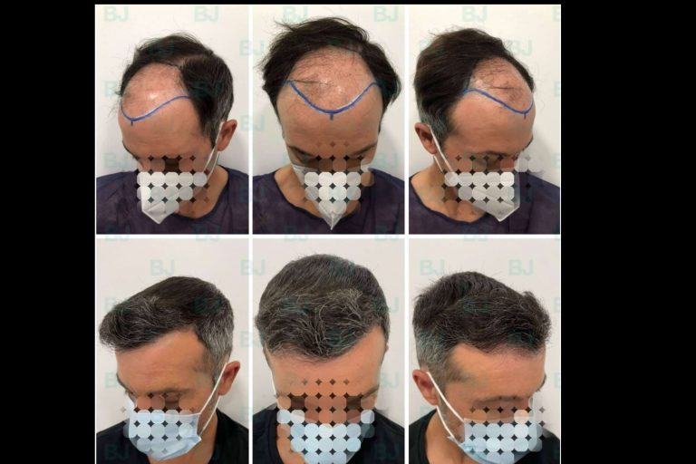 Dr. Bruno Jacobovski, uno de los pocos doctores en Europa que combina las técnicas FUE y FUSS/FUT en la reconstrucción capilar de cicatrices y quemaduras