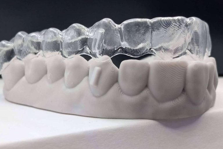 Los sistemas novedosos de Smile Aligner como ortodoncia invisible