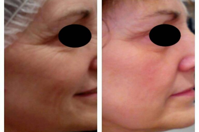 Conseguir una piel de porcelana con tratamiento facial antimanchas y otros tratamientos faciales icónicos de la compañía MiCleo&Co