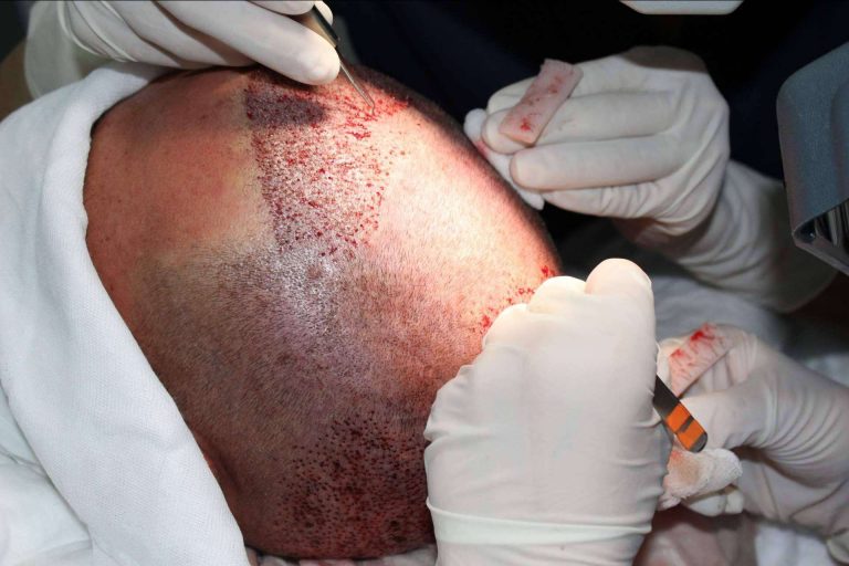 Las ventajas de Injermur, la clínica de injerto capilar en Murcia especializada en el injerto sin cicatriz