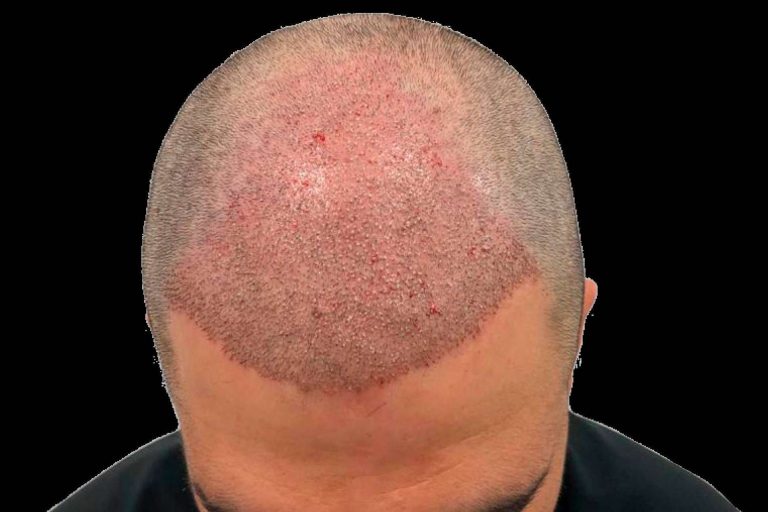 ¿Por qué realizarse un injerto capilar en España y no en Turquía?, según Clínicas Be